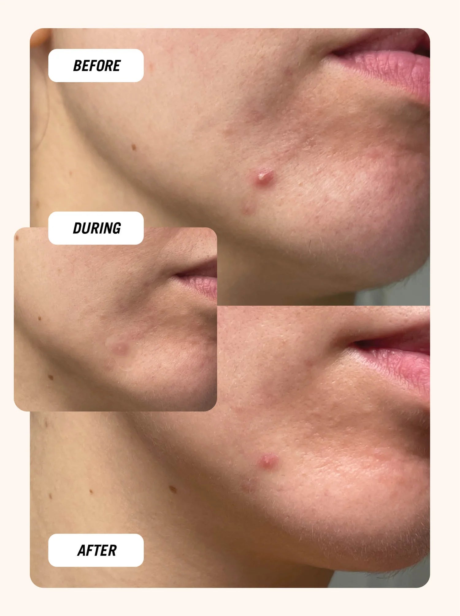 Cloud Patch - Pimple Patch