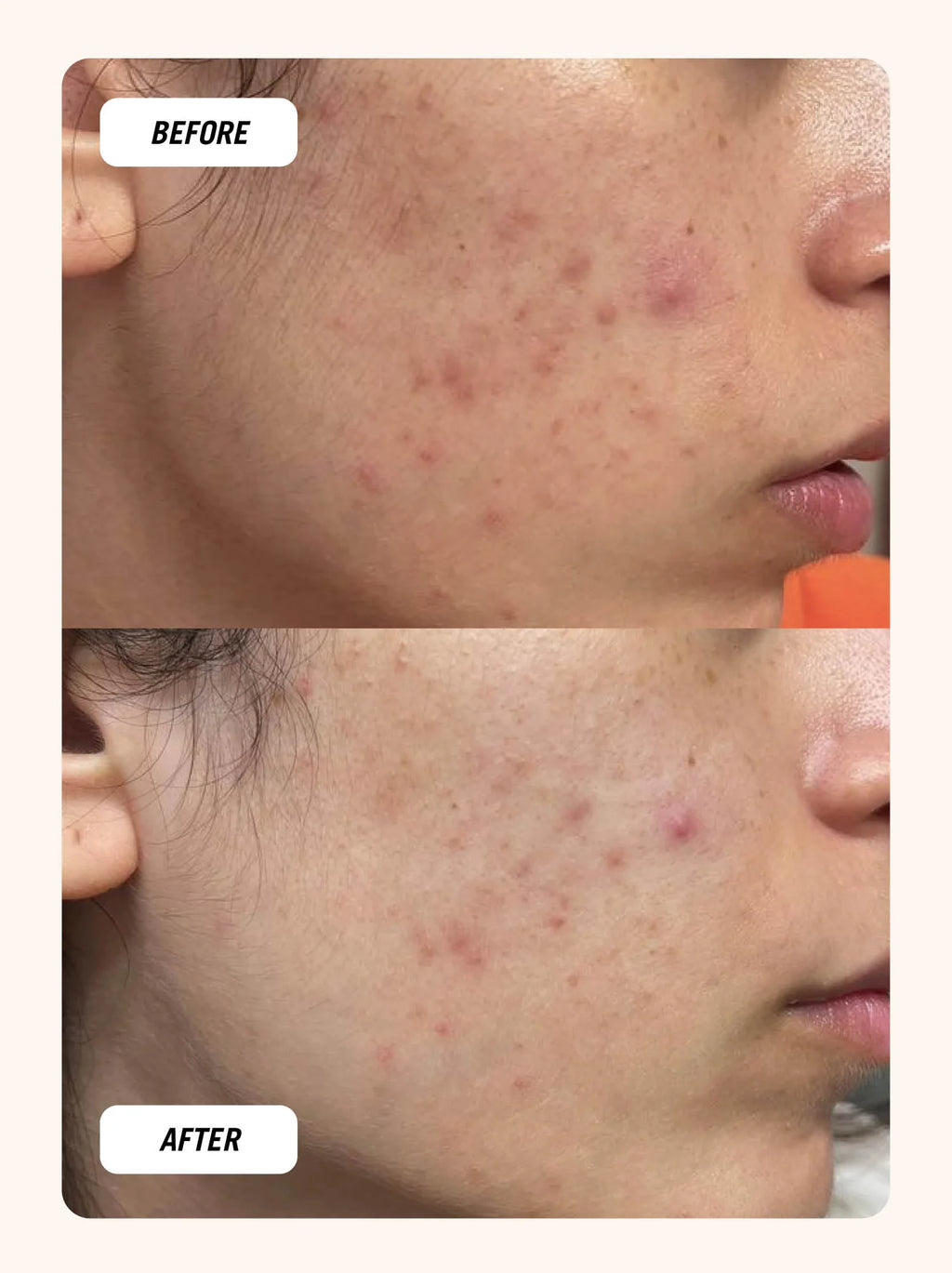 Moon Patch - Acne Pimple Patches
