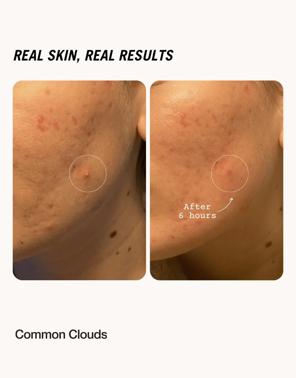 Cloud Patch - Pimple Patch