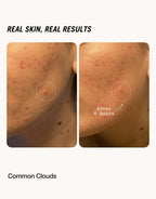 Cloud Patch - Pimple Patch